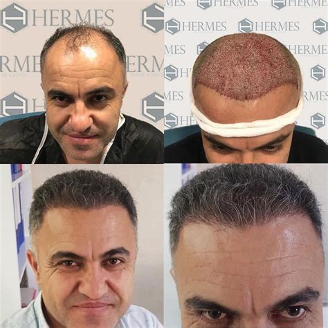 hermes clinic istanbul|best hair transplant clinic istanbul.